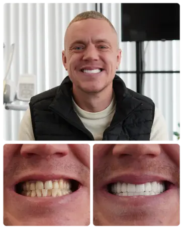 Hollywood Smile transformation — Thomas